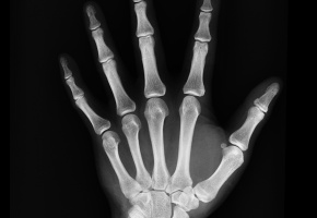 X-ray of hand